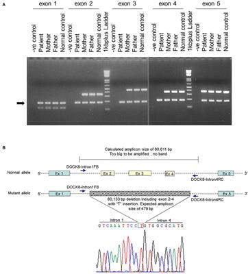 Hyper IgE Syndrome Associated With Warts: A First Case of Dedicator of Cytokinesis 8 Deficiency in the Philippines